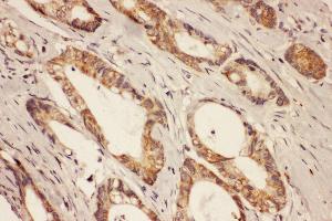 Anti-RAB8A antibody, IHC(P) IHC(P): Human Intestinal Cancer Tissue (RAB8A antibody  (C-Term))