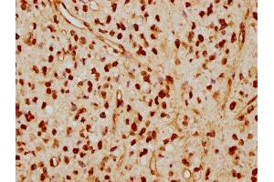 IHC image of ABIN7127601 diluted at 1:115 and staining in paraffin-embedded human glioma cancer performed on a Leica BondTM system.