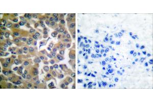 Peptide - +Immunohistochemical analysis of paraffin-embedded human breast carcinoma tissue, using FAP-1 antibody. (FAP antibody)