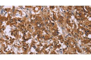 Immunohistochemistry of paraffin-embedded Human thyroid cancer using CMTM6 Polyclonal Antibody at dilution of 1:30 (CMTM6 antibody)
