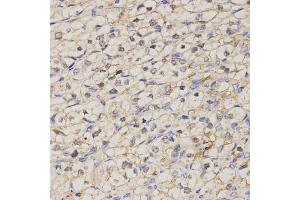 Immunohistochemistry of paraffin-embedded human kidney cancer using GJC2 antibody (ABIN5971490) at dilution of 1/200 (40x lens). (GJC2 antibody)