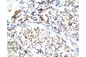 Formalin-fixed and paraffin embedded human endometrium carcinoma with Anti-CGRP/CGRP2 Polyclonal Antibody, Unconjugated (ABIN728218) at 1:200, followed by conjugation to the secondary antibody and DAB staining (CGRP antibody  (AA 65-130))