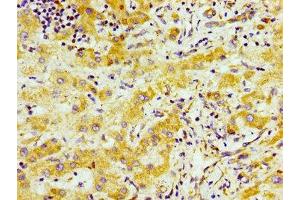 Immunohistochemistry of paraffin-embedded human liver cancer using ABIN7170696 at dilution of 1:100 (SND1 antibody  (AA 560-732))