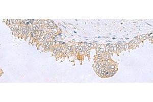 Immunohistochemistry of paraffin-embedded Human prost ate cancer tissue using GPCPD1 Polyclonal Antibody at dilution of 1:55(x200) (GPCPD1 antibody)