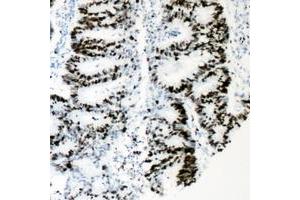 Immunohistochemical analysis of HNF4 alpha (pS313) staining in human colon cancer formalin fixed paraffin embedded tissue section.
