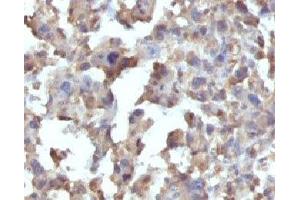 Formalin-fixed, paraffin-embedded human Histiocytoma stained with TNF alpha antibody (TNFA/1172)