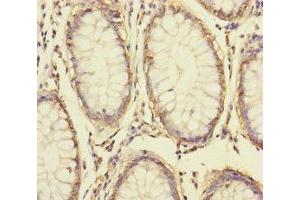 Immunohistochemistry of paraffin-embedded human colon cancer using ABIN7166047 at dilution of 1:100 (S1A14 (AA 1-104) antibody)