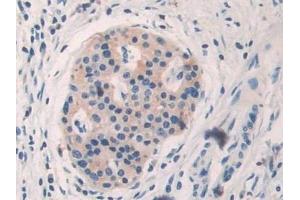Detection of BARK in Human Pancreatic cancer Tissue using Polyclonal Antibody to Beta Adrenergic Receptor Kinase (BARK) (beta-Adrenergic Receptor Kinase (AA 398-640) antibody)