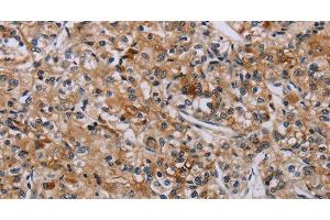 Immunohistochemistry of paraffin-embedded Human prostate cancer tissue using AATK Polyclonal Antibody at dilution 1:45