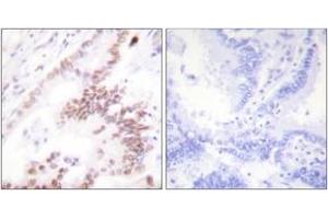 Immunohistochemistry analysis of paraffin-embedded human lung carcinoma tissue, using p300 Antibody. (p300 antibody  (AA 1-50))