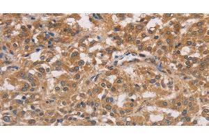 Immunohistochemistry of paraffin-embedded Human thyroid cancer tissue using DSTN Polyclonal Antibody at dilution 1:30 (Destrin antibody)