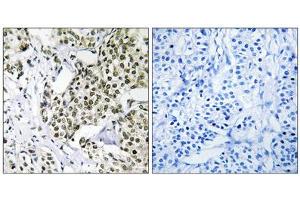 Immunohistochemistry analysis of paraffin-embedded human breast carcinoma tissue using CAGE1 antibody. (CAGE1 antibody  (C-Term))