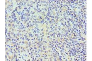 Immunohistochemistry of paraffin-embedded human breast cancer using ABIN7171508 at dilution of 1:100 (TARDBP antibody  (AA 1-260))
