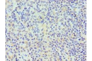 Immunohistochemistry of paraffin-embedded human breast cancer using ABIN7171508 at dilution of 1:100
