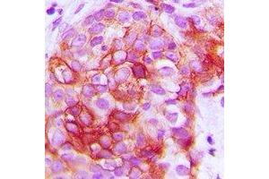 Immunohistochemical analysis of GIP Receptor staining in human breast cancer formalin fixed paraffin embedded tissue section. (GIPR antibody)