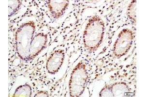 Formalin-fixed and paraffin embedded human gastric cancer labeled with Anti-C-Myc Polyclonal Antibody, Unconjugated (ABIN1387773) at 1:200 followed by conjugation to the secondary antibody and DAB staining (c-MYC antibody  (AA 101-200))