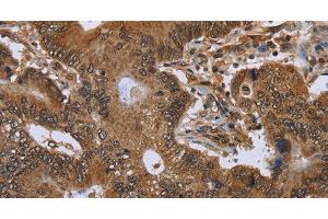 Immunohistochemistry of paraffin-embedded Human colon cancer using FHIT Polyclonal Antibody at dilution of 1:30 (FHIT antibody)
