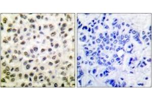 Immunohistochemistry analysis of paraffin-embedded human breast carcinoma tissue, using STAT5B (Ab-731) Antibody. (STAT5B antibody  (AA 697-746))