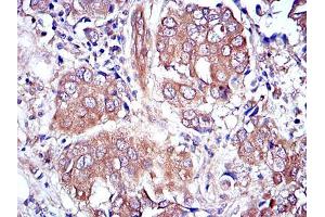 Immunohistochemical analysis of paraffin-embedded breast cancer tissues using MAPK3 mouse mAb with DAB staining. (ERK1 antibody)