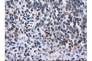 Immunohistochemical staining of paraffin-embedded colon tissue using anti-TTLL12mouse monoclonal antibody. (TTLL12 antibody)