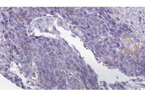 ABIN6279509 at 1/100 staining Human Head and neck cancer tissue by IHC-P. (KCNJ13 antibody  (Internal Region))