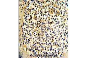 Formalin-fixed and paraffin-embedded human kidney carcinoma with DCXR Antibody , which was peroxidase-conjugated to the secondary antibody, followed by DAB staining.