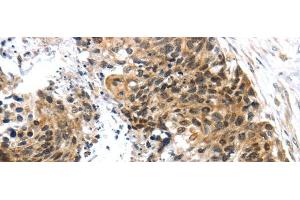 Immunohistochemistry of paraffin-embedded Human esophagus cancer tissue using TRIM74 Polyclonal Antibody at dilution 1:45 (TRIM74 antibody)