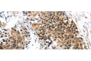 Immunohistochemistry of paraffin-embedded Human esophagus cancer tissue using TRIM74 Polyclonal Antibody at dilution 1:45 (TRIM74 antibody)