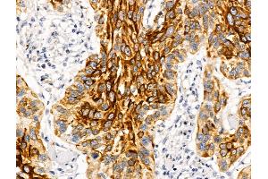 ABIN6262775 and ABIN6269025 at 1/100 staining Human esophageal cancer by IHC-P.