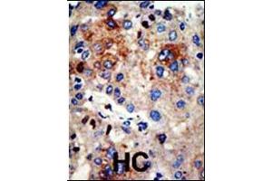Formalin-fixed and paraffin-embedded human cancer tissue reacted with the primary antibody, which was peroxidase-conjugated to the secondary antibody, followed by AEC staining. (HDAC9 antibody  (N-Term))