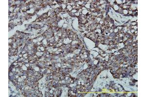 Immunoperoxidase of monoclonal antibody to GPR3 on formalin-fixed paraffin-embedded human transitional cell carcinoma tissue. (GPR3 antibody  (AA 1-330))