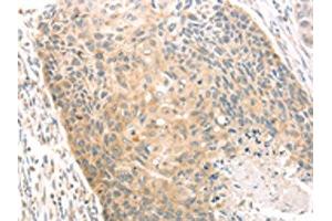 The image on the left is immunohistochemistry of paraffin-embedded Human esophagus cancer tissue using ABIN7130971(SCAP Antibody) at dilution 1/20, on the right is treated with fusion protein. (SREBF chaperone antibody)