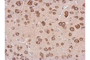 IHC-P Image Immunohistochemical analysis of paraffin-embedded CL1-5 xenograft, using cystatin F, antibody at 1:500 dilution. (CST7 antibody)