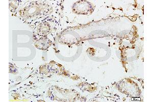 Formalin-fixed and paraffin embedded human colon carcinoma tissue labeled with Rabbit Anti-TEM1/CD248 Polyclonal Antibody (ABIN677573) at 1:200 followed by conjugation to the secondary antibody and DAB staining. (CD248 antibody  (AA 251-350))