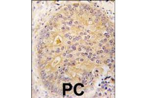 Formalin-fixed and paraffin-embedded human prostata carcinoma tissue reacted with CAMKK2 antibody , which was peroxidase-conjugated to the secondary antibody, followed by DAB staining. (CAMKK2 antibody  (N-Term))
