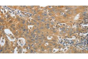 Immunohistochemistry of paraffin-embedded Human ovarian cancer using Amphiphysin I Polyclonal Antibody at dilution of 1:30 (Amphiphysin antibody)