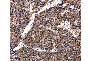 Immunohistochemistry of Human liver cancer using CUL4A Polyclonal Antibody at dilution of 1:62 (Cullin 4A antibody)