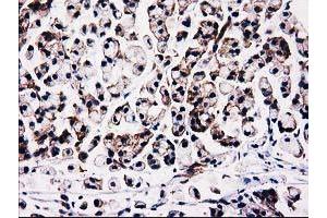 Immunohistochemical staining of paraffin-embedded Adenocarcinoma of Human colon tissue using anti-FAM40A mouse monoclonal antibody.