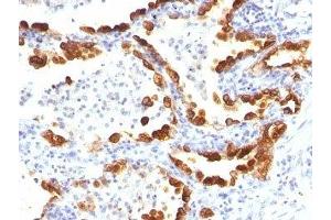 Formalin-fixed, paraffin-embedded human lung carcinoma stained with Cytokeratin 18 antibody (KRT18/835).