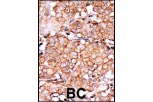 Formalin-fixed and paraffin-embedded human cancer tissue reacted with the primary antibody, which was peroxidase-conjugated to the secondary antibody, followed by AEC staining. (RAD9A antibody  (pSer328))