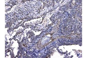 IHC testing of FFPE human lung cancer tissue with GSTM3 antibody at 1ug/ml. (GSTM3 antibody)