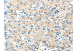 The image on the left is immunohistochemistry of paraffin-embedded Human liver cancer tissue using ABIN7189804(ANGPTL5 Antibody) at dilution 1/25, on the right is treated with synthetic peptide. (ANGPTL5 antibody)