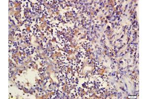 Formalin-fixed and paraffin embedded human laryngeal tissue  labeled with Rabbit Anti-DcR2/TNFRSF10D Polyclonal Antibody, Unconjugated (ABIN733088) at 1:200 followed by conjugation to the secondary antibody and DAB staining (DcR2 antibody)