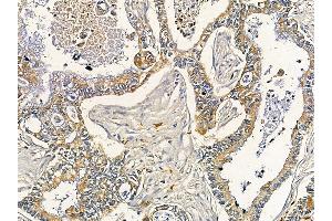 ABIN6261318 and ABIN6266877 at 1/100 staining human pancreatic cancer by IHC-P. (DMPK antibody  (N-Term))