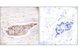 Immunohistochemistry analysis of paraffin-embedded human breast carcinoma tissue, using Annexin A6 Antibody. (ANXA6 antibody  (AA 1-50))