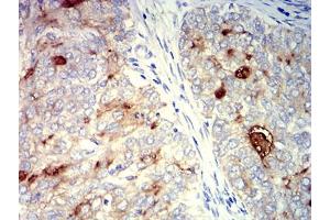 Immunohistochemical analysis of paraffin-embedded cervical cancer tissues using CD227 mouse mAb with DAB staining. (MUC1 antibody  (AA 66-175))
