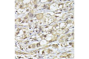 Immunohistochemistry of paraffin-embedded human liver cancer using PSMB3 antibody (ABIN6131929, ABIN6146317, ABIN6146318 and ABIN6225280) at dilution of 1:100 (40x lens). (PSMB3 antibody  (AA 1-205))