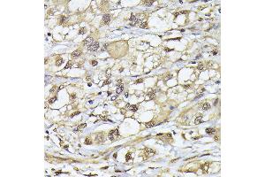 Immunohistochemistry of paraffin-embedded human liver cancer using PSMB3 antibody (ABIN6131929, ABIN6146317, ABIN6146318 and ABIN6225280) at dilution of 1:100 (40x lens). (PSMB3 antibody  (AA 1-205))