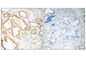 Immunohistochemistry analysis of paraffin-embedded human colon carcinoma tissue using SEPT6 antibody. (Septin 6 antibody  (Internal Region))