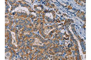 The image is immunohistochemistry of paraffin-embedded Human thyroid cancer tissue using ABIN7131284(TAB3 Antibody) at dilution 1/25. (TAB3 antibody)